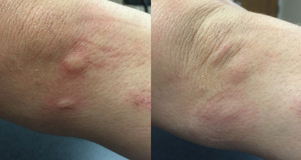 mosquito bite remedy